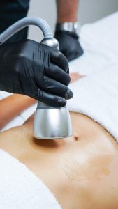 Cryo belly fat sculpting