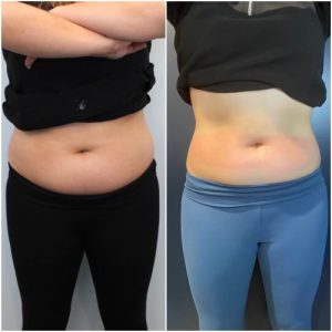 cryo body sculpting